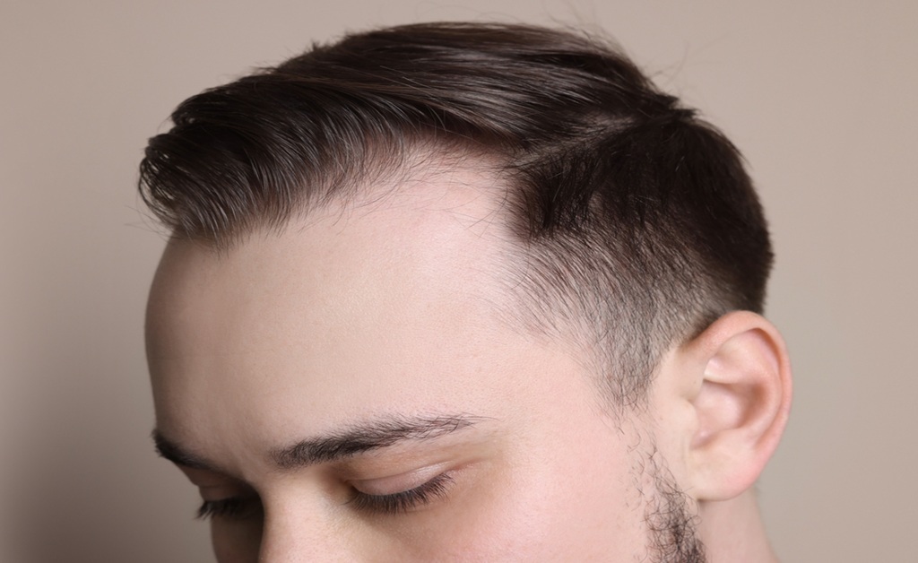 Haircuts for Guys with Receding Hairlines