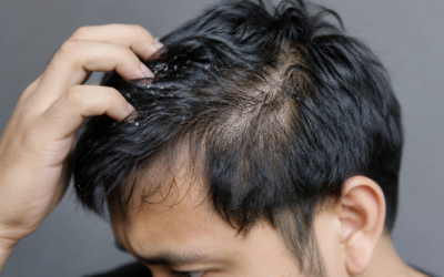 Can Dandruff Cause Hair Loss and Thinning Hair?