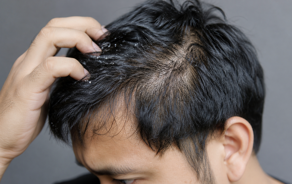Dandruff Cause Hair Loss and Thinning Hair