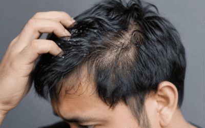 Can Dandruff Cause Hair Loss and Thinning Hair?