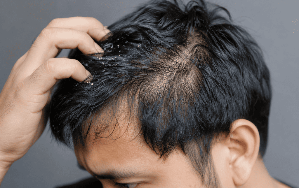 Dandruff Cause Hair Loss and Thinning Hair